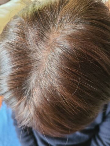 発毛・育毛効果をアップさせたい！薄毛の原因や対処法を解説